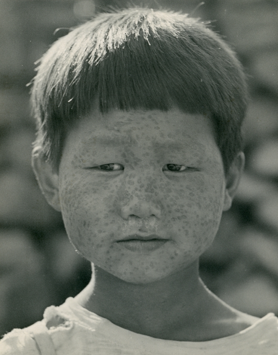 곰보 자국이 있는 아이